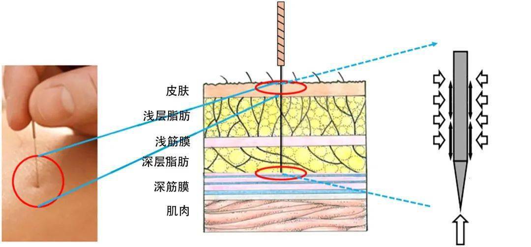 瘢痕组织画图图片