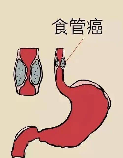 全球近一半的食管癌在中国和这些坏习惯有关快来看你有没有