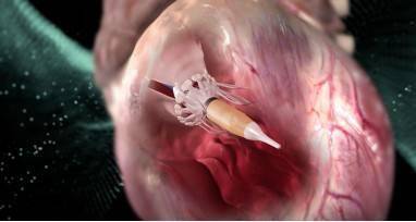 相对于主动脉瓣置换,二尖瓣置换的技术难度在于二尖瓣环在整个心动