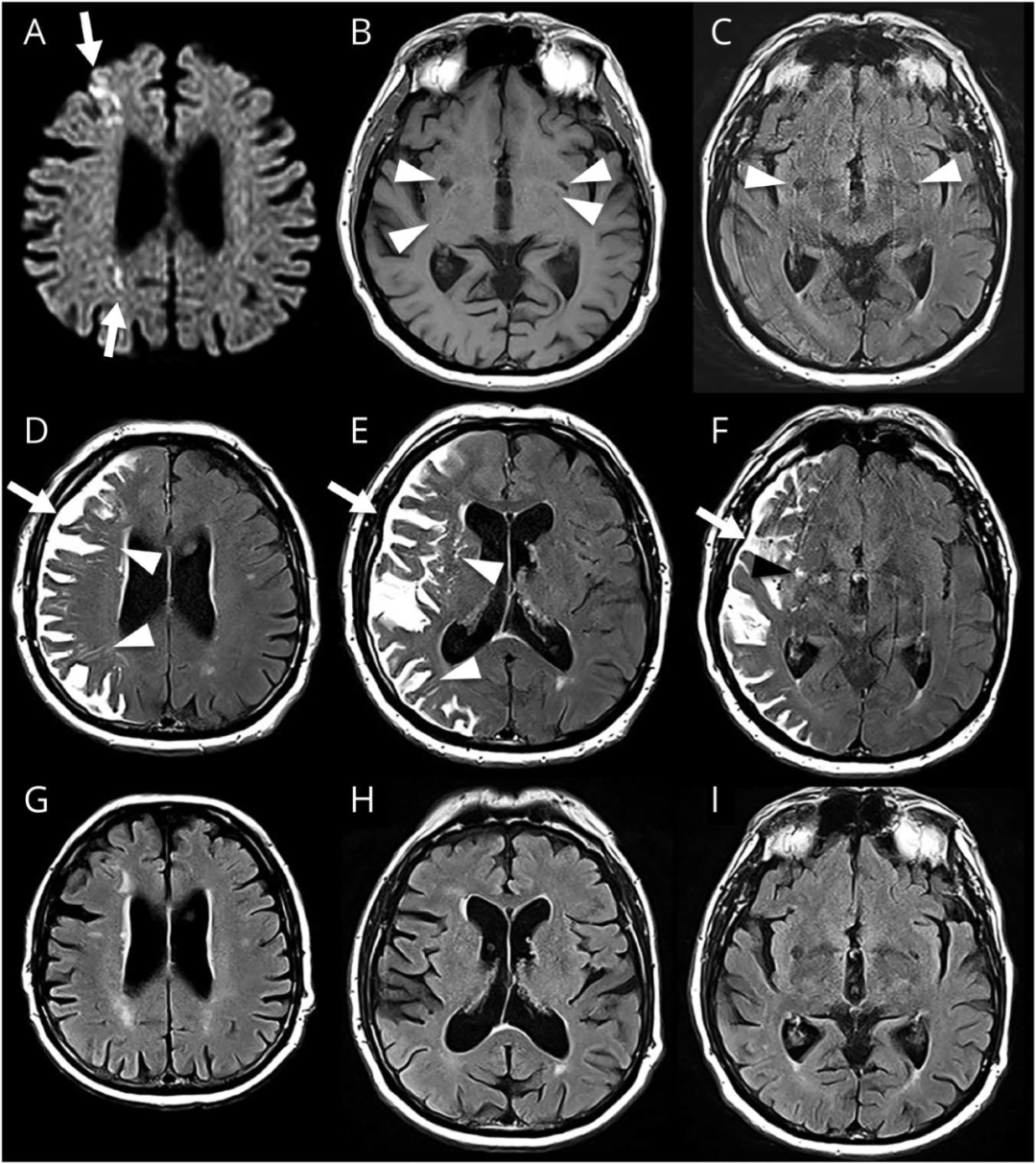 显示|Neurology：脑淋巴系统一例