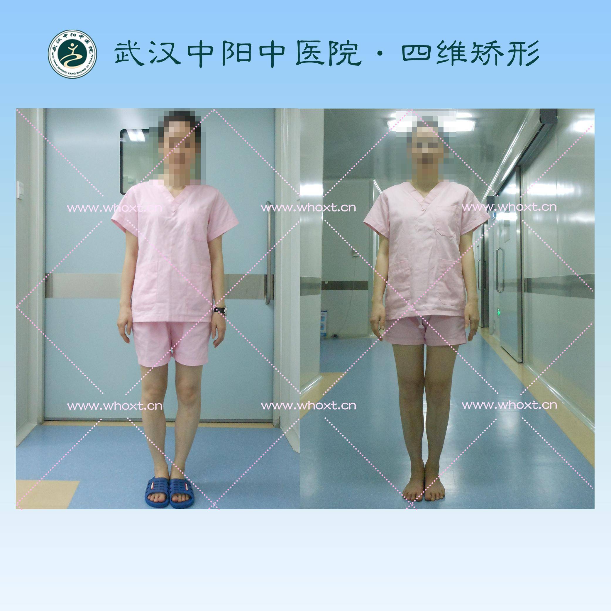 武汉中阳中医院四维矫形技术,更多o型腿患友的选择