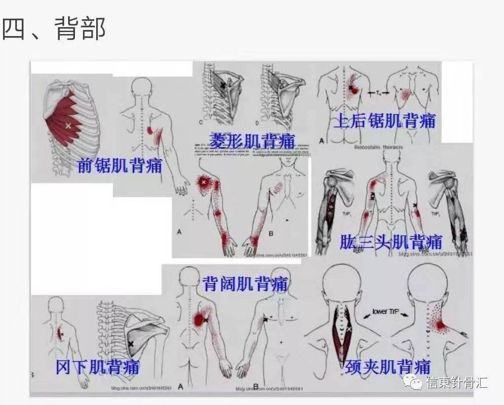 肌筋膜全身160个疼痛触发点