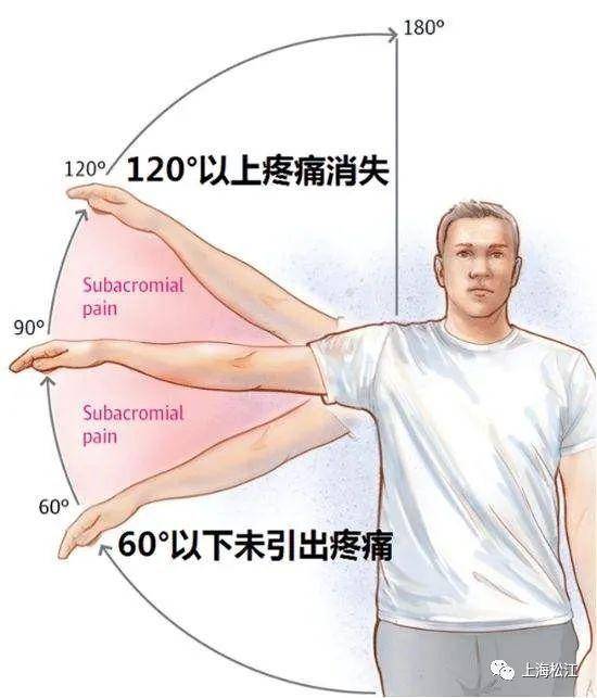 肩袖损伤位置图片图片