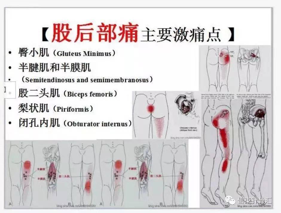 肌筋膜全身160个疼痛触发点