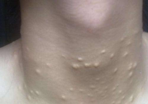 女性脖子脂肪粒的图片图片