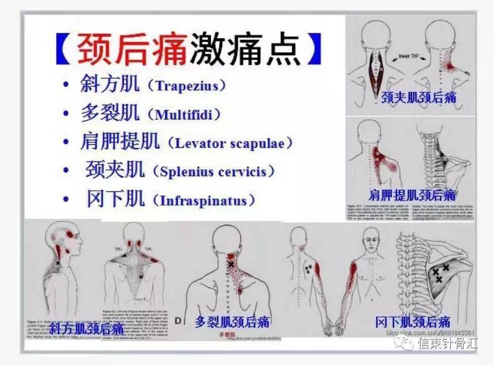 肌筋膜全身160个疼痛触发点