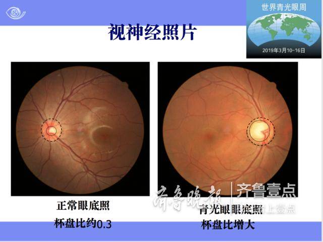 超过21mmhg),特征性视神经改变(视神经照相