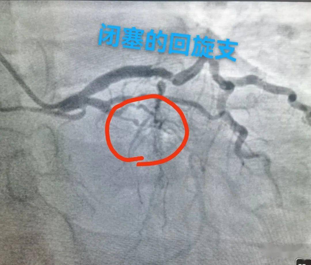 一根迴旋支閉塞了,一根右冠狀動脈閉塞了,唯一一個通著的血管前降支