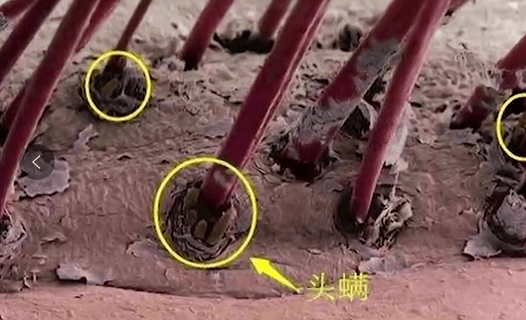 (想想就恶心)这些泥状头皮屑不是螨虫的尸体,而是他们吃喝后留下的