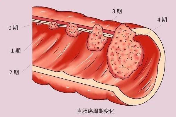 肠癌除了会有便血还有哪些常见表现有哪些治疗方法听医生说