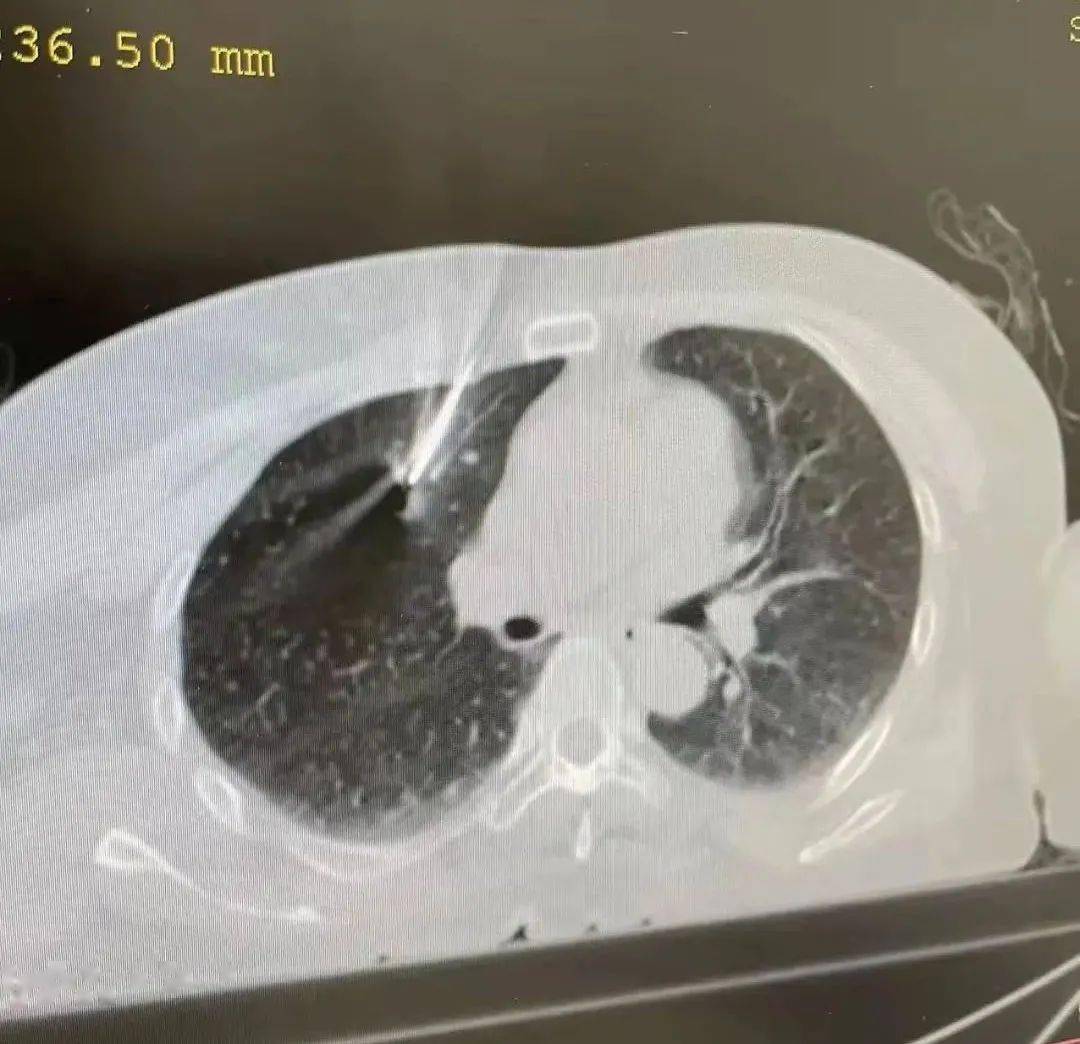 成功|【新闻快递】医院成功实施经皮穿透肋软骨肺穿刺活检术