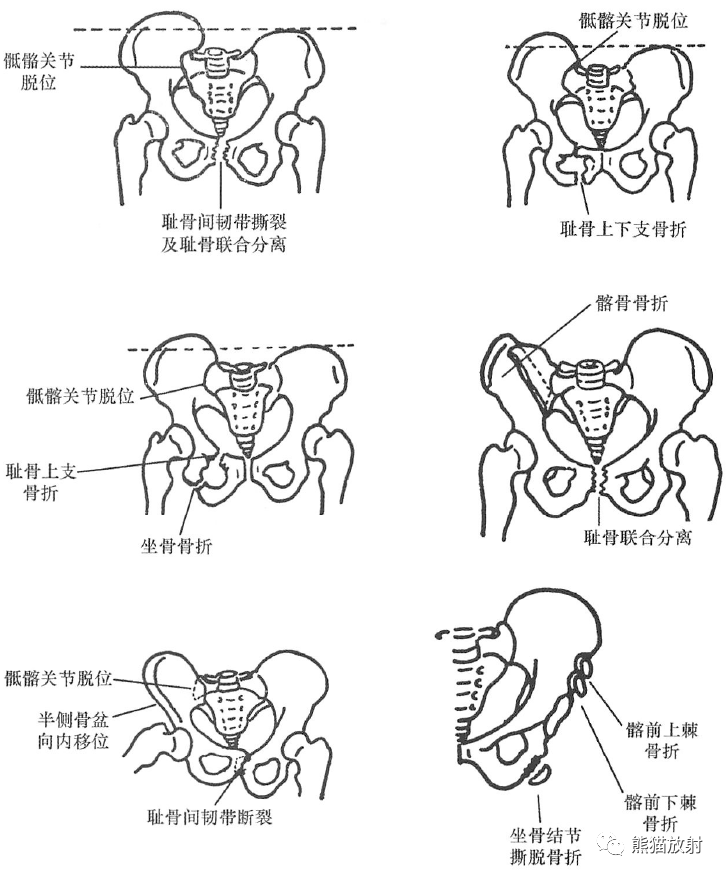 骨盆骨折分类图片