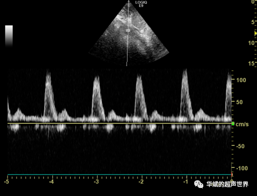 血流_诊断_频谱