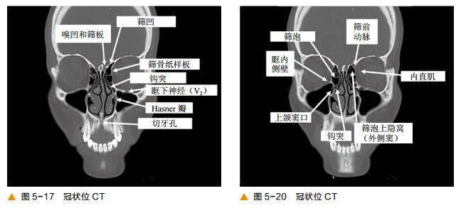 顱底及鼻竇ct軸冠矢解剖