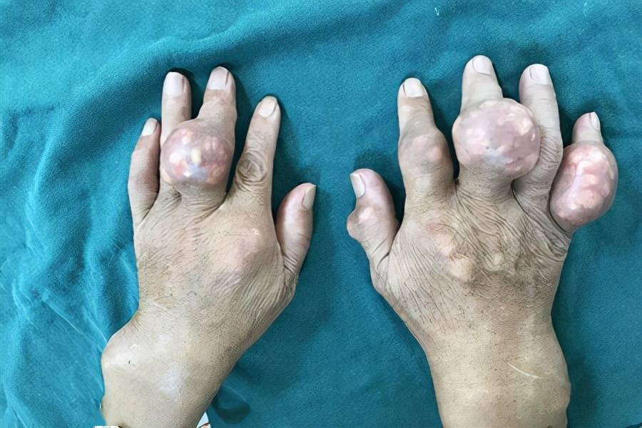 出现关节痛分不清是痛风还是骨关节炎医生直言2招轻松搞定