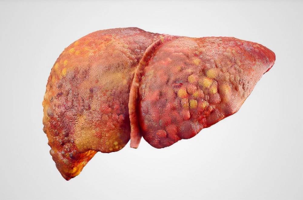 肾结石一般多久能长成大石头 bf9c2c5530f54d4ab3e6f3fea3d1fce5.jpeg