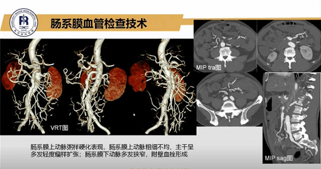 图2:肝脏血管(上)及肠系膜血管(下)cta检查图像具体操作数据见表1