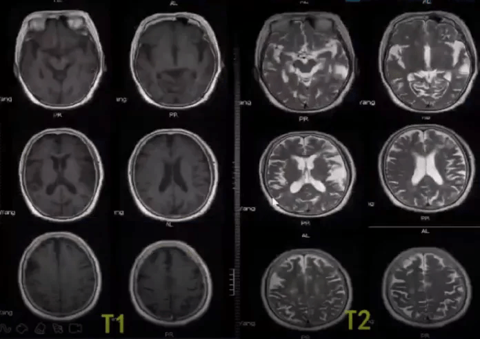 治疗|急性脑梗死MRI的临床特点，超强解读