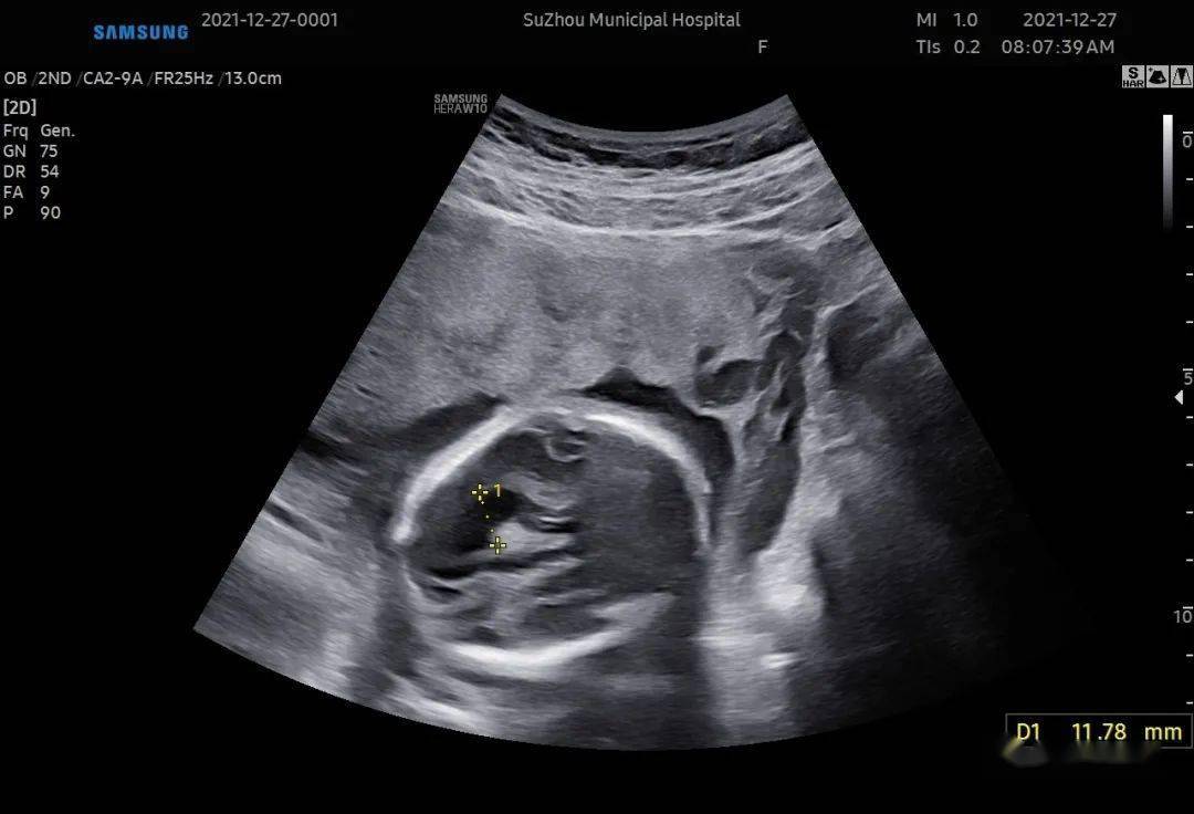 77单纯足内翻,脑部正常,脊柱正常,有充分的信心!