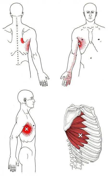 前锯肌(serratus anterior)疼痛在肩部外旋时加重3)手前侧/后侧2)前臂