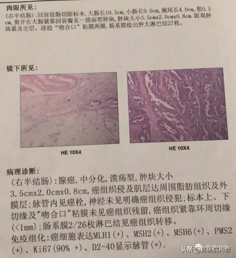 带你解读结直肠癌病理结果