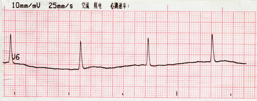 心搏骤停心电图图片