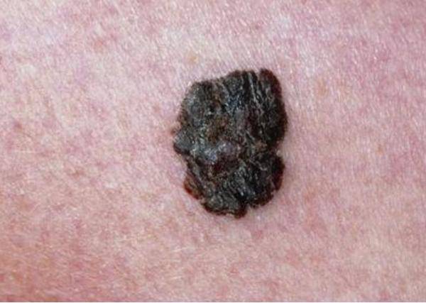 医生提醒:若黑痣长在这3个部位,建议大家要引起高度重视_恶性肿瘤