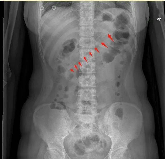 感觉|女子感觉咽喉有异物用勺子抠喉 不慎把勺子吞了下去