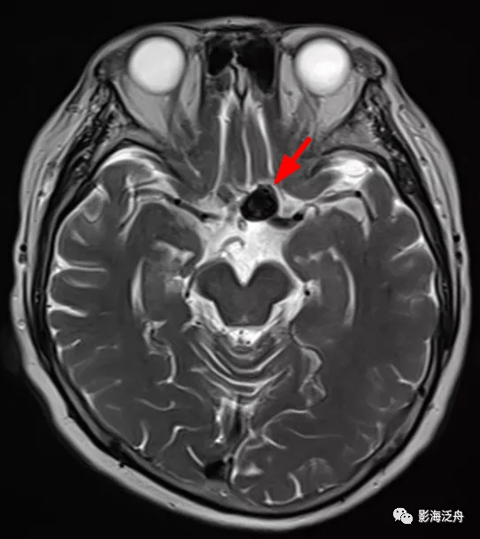 诊断|颅脑MR平扫中极易漏诊的点