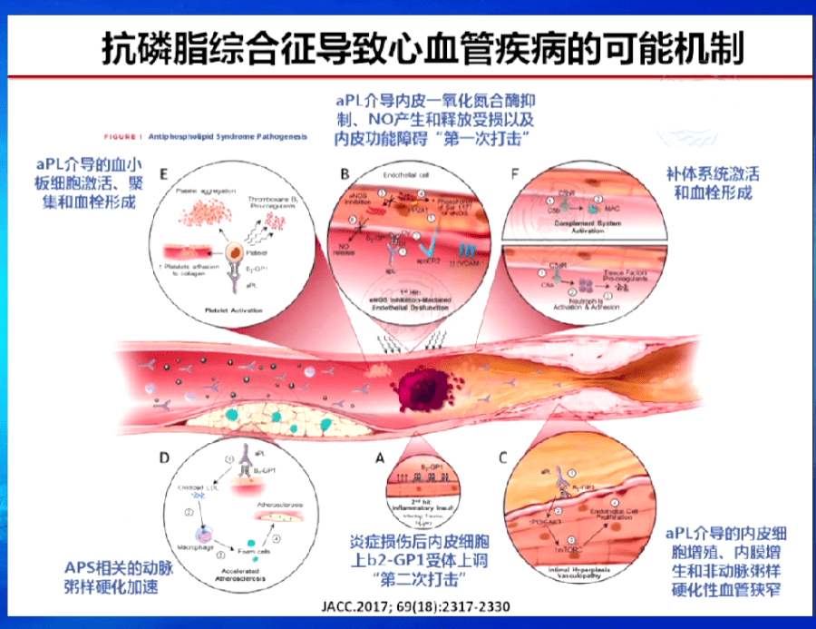 aps相关心血管疾病有5类诊治须知3个重点
