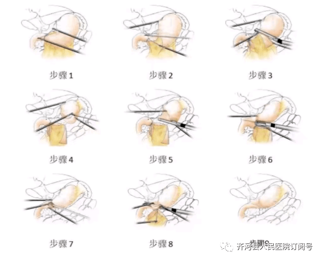 腹腔镜_手术_delta
