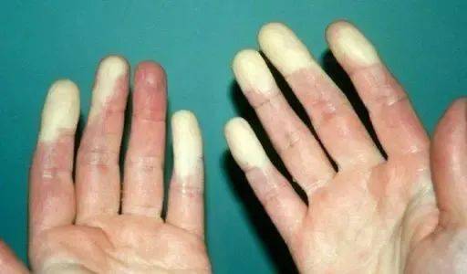风湿|年轻女子冻到手指苍白背后……注意，可能是种免疫病！
