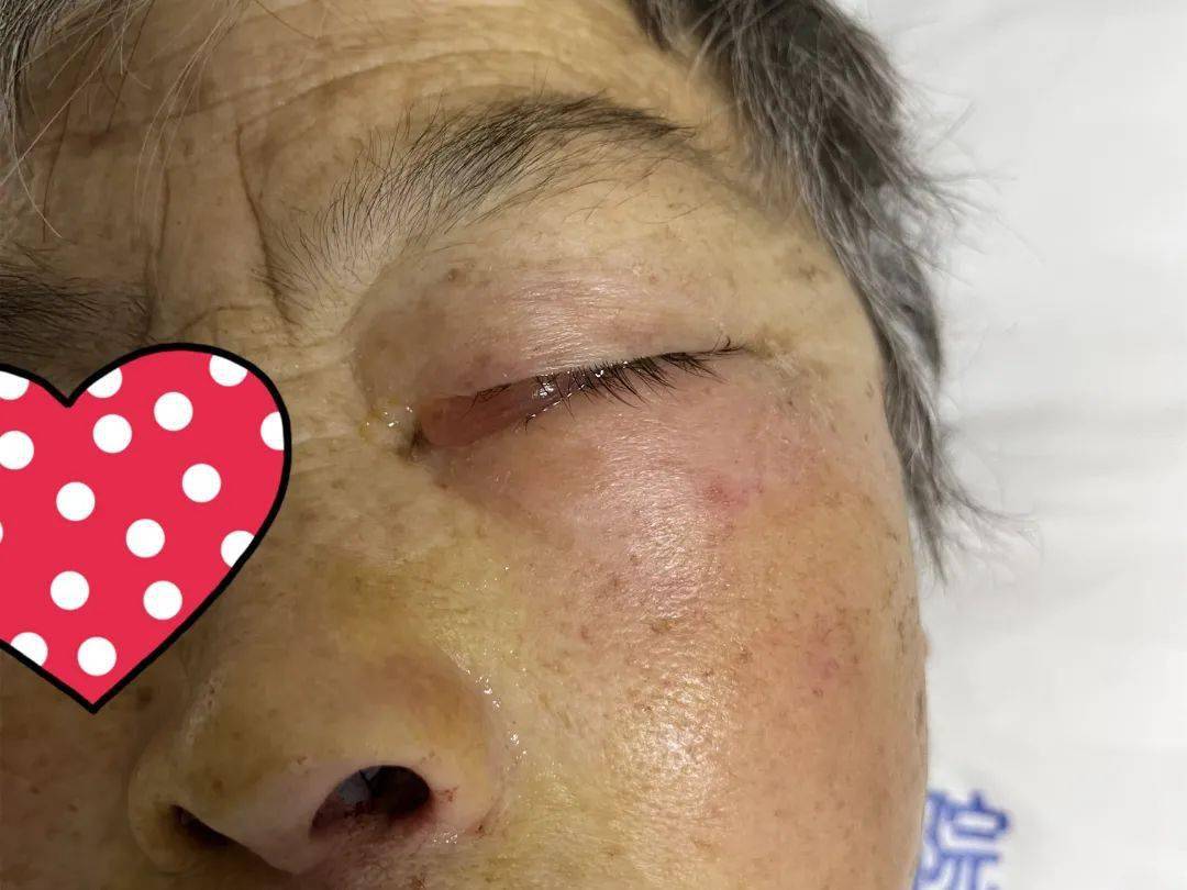 67岁老人因高热住进icu鼻阻流涕眼睛红肿视力险丧失竟是