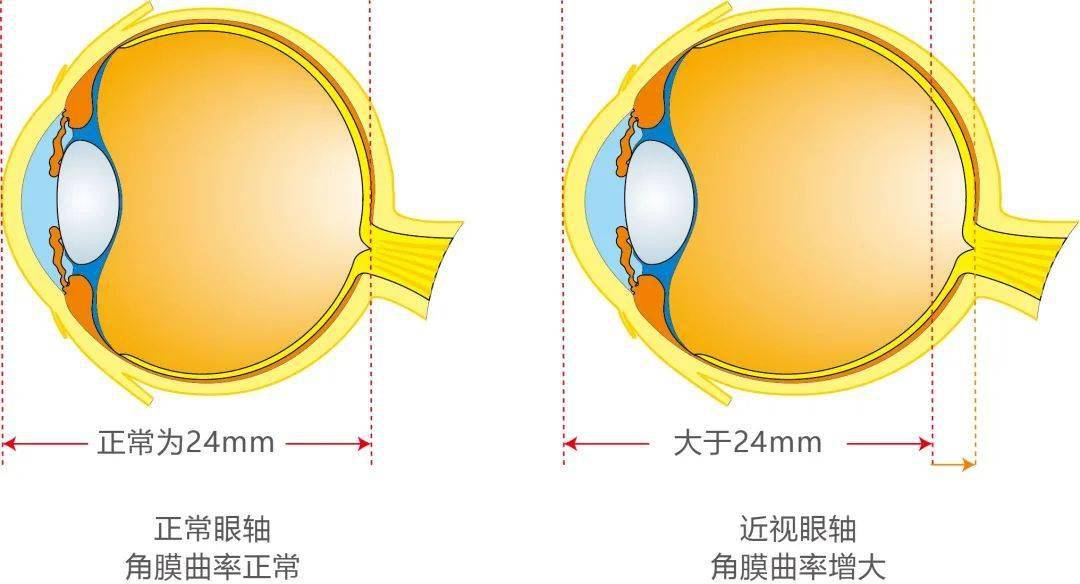 青少年近视防控镜片多少钱 e5d3255d22ee428b90c913e98f4eb3db.jpeg