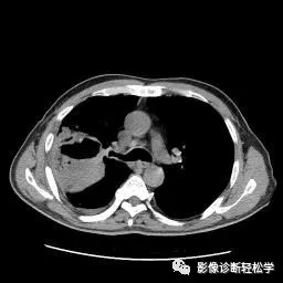 症状|“超低价”种了颗牙，结果住进ICU，肺部啃出无数个洞