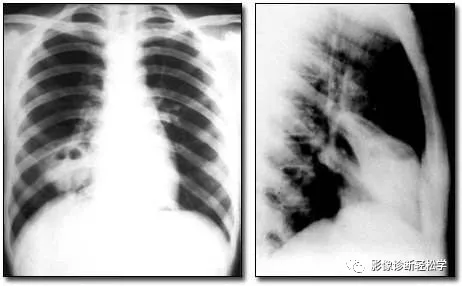 症状|“超低价”种了颗牙，结果住进ICU，肺部啃出无数个洞