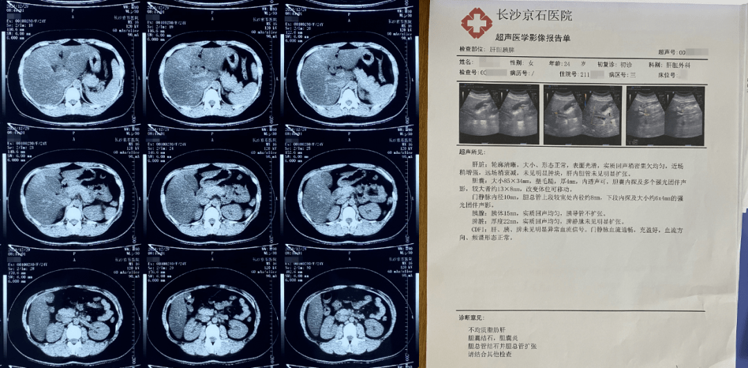 胆囊炎彩超报告单图片图片