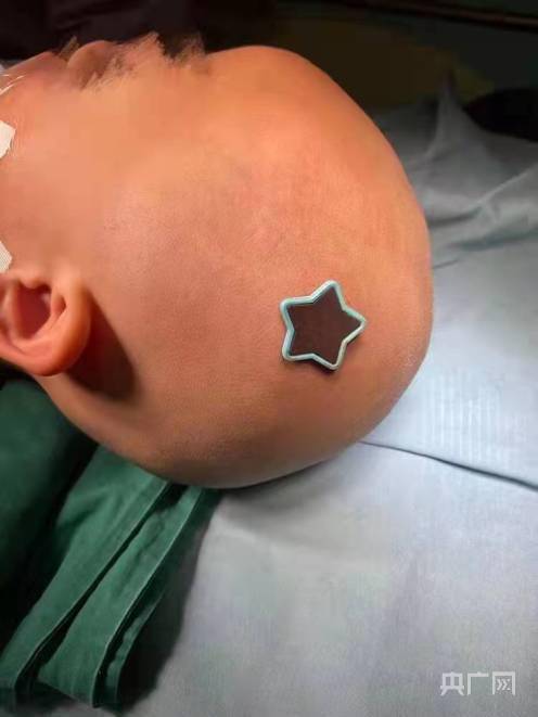 手术|这颗“星星”够吓人 紧急送医后顺利“摘星”