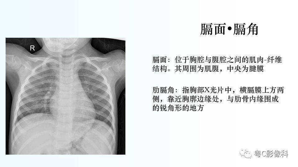 儿童桶状胸图片