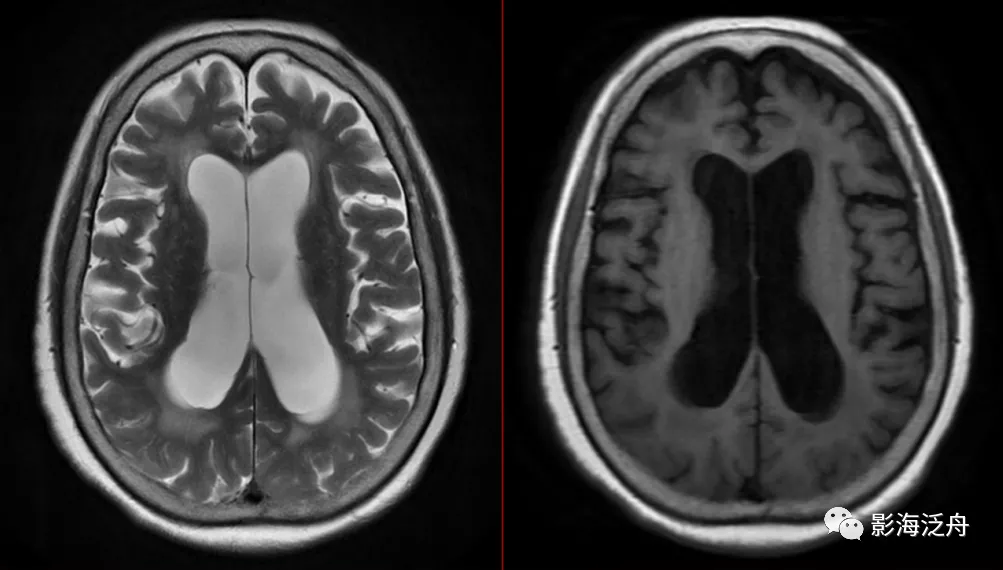 诊断|小心误诊，这可不是单纯的脑萎缩