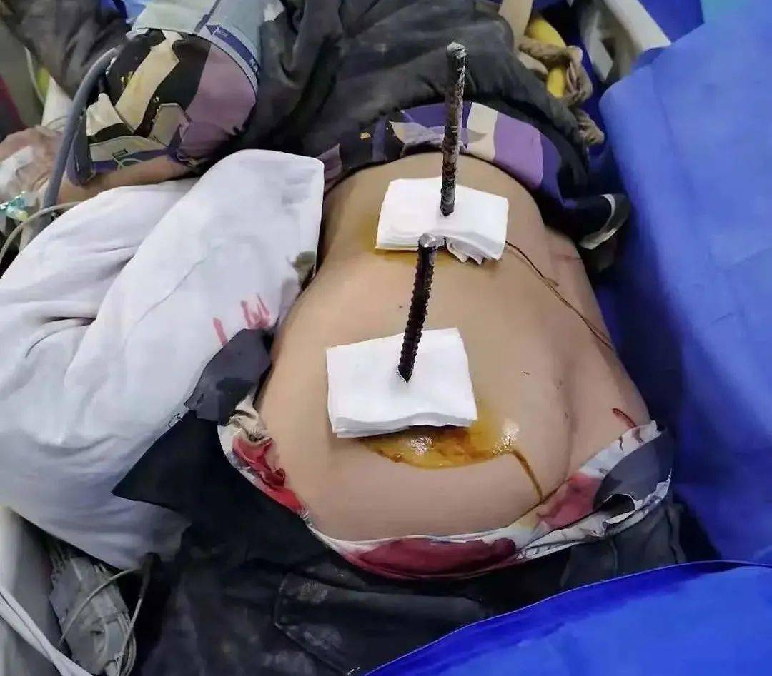 痛呀广西一男子身体被2根钢筋贯穿
