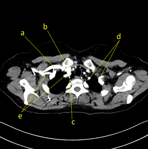 圖1胸部ct顯示的右側鎖骨下靜脈(a)右頸內靜脈;(b)右頸動脈;(c)左鎖骨