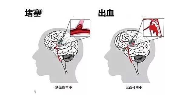 控制|冬季高发！比癌症更可怕的脑卒中，该如何预防？