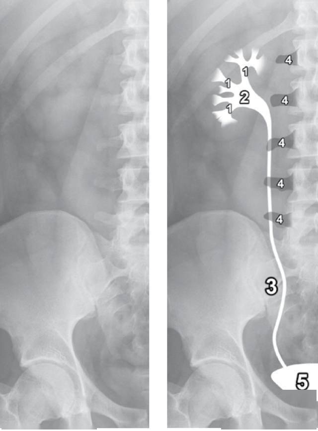 带你看遍腹平片上的钙化,教科书上可没有!_胆囊_腹部_输尿管