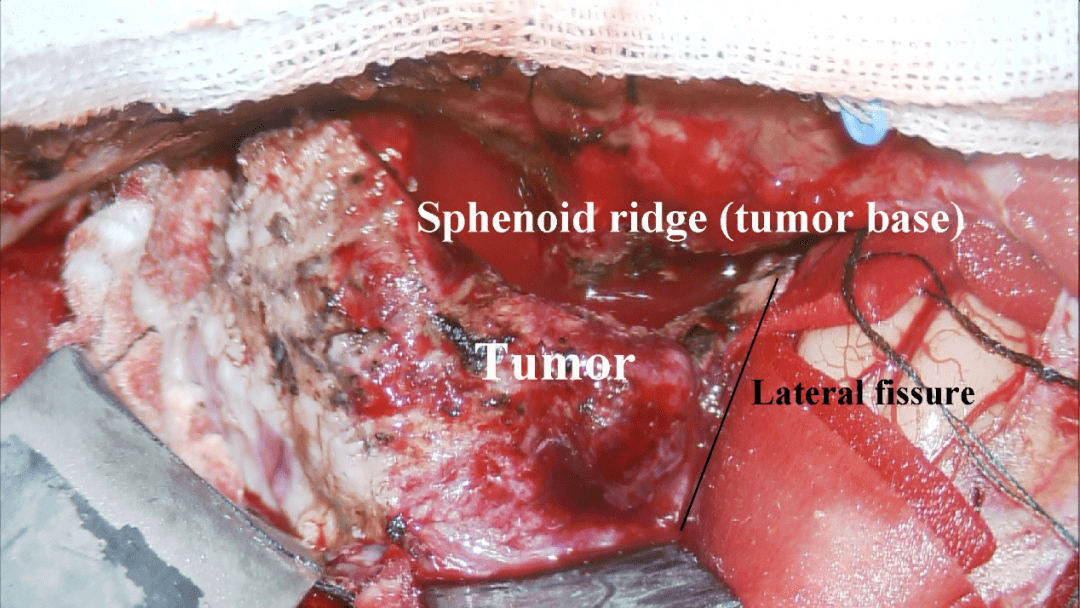 【病例分享】复旦大学附属华山医院神经外科徐荣教授&汤海亮博士:蝶骨