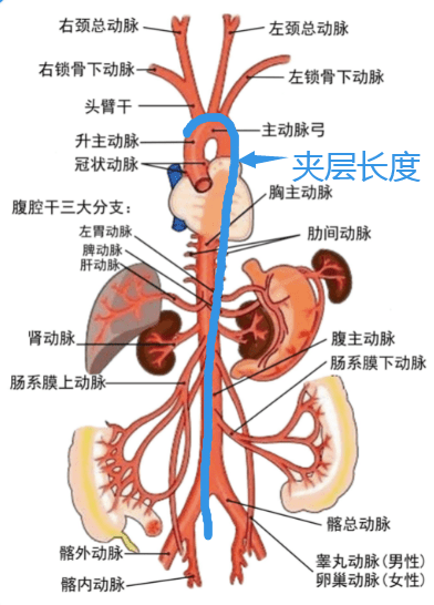 杨女士主动脉夹层,累及弓上三支,系膜上动脉及两侧髂总,髂外动脉,是