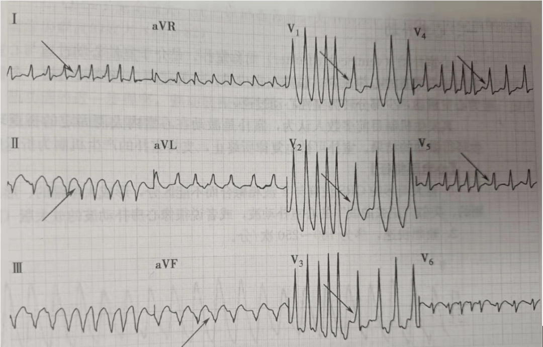 室颤与室扑心电图特点图片
