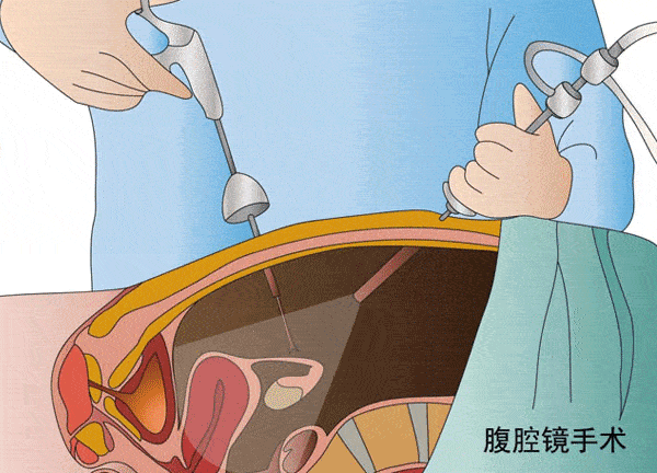宫腹腔镜联合手术开启您好孕梦想