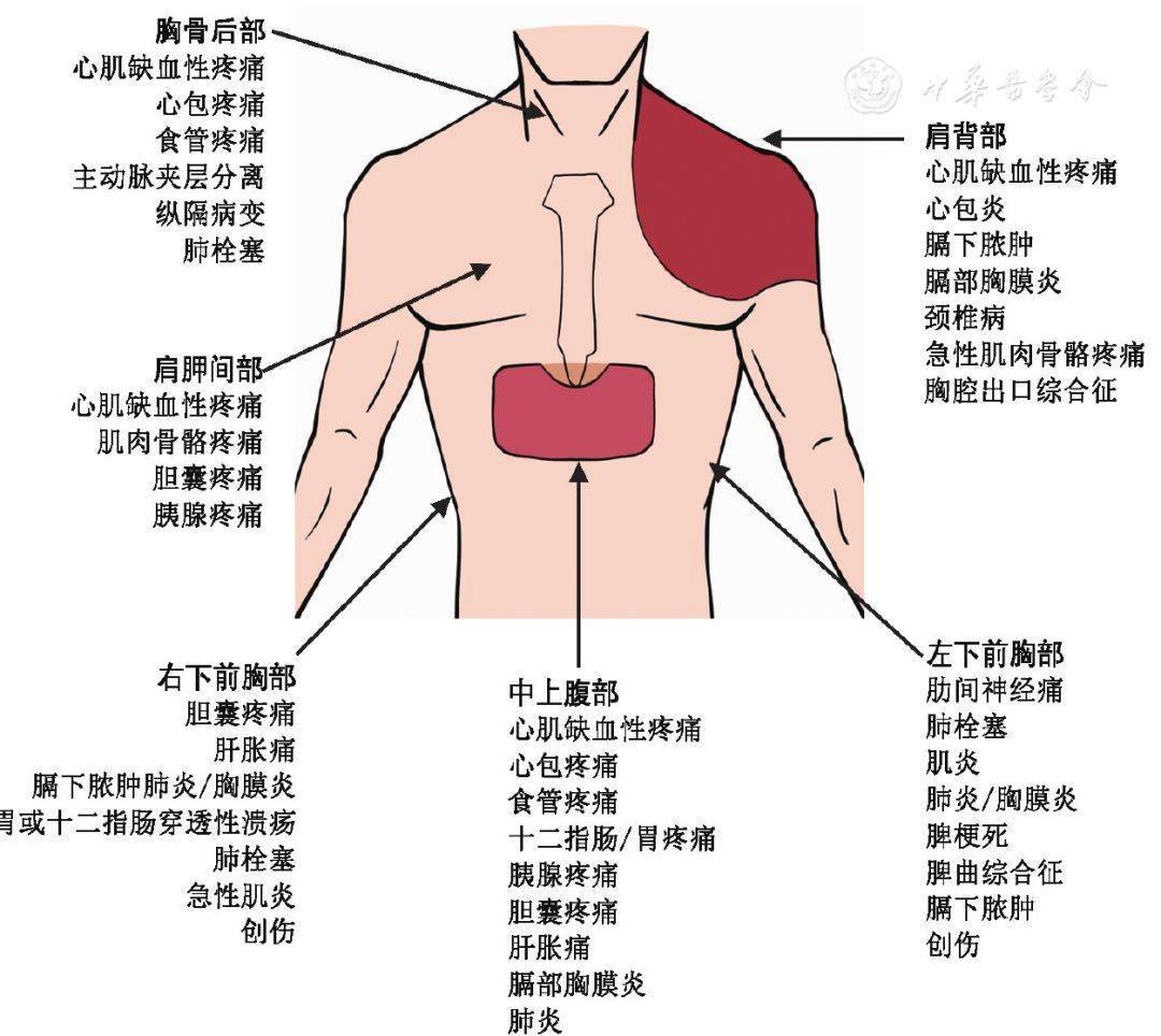 十分重要,包括:①是否为新发的,急性的和持续性的胸痛;②胸痛的部位