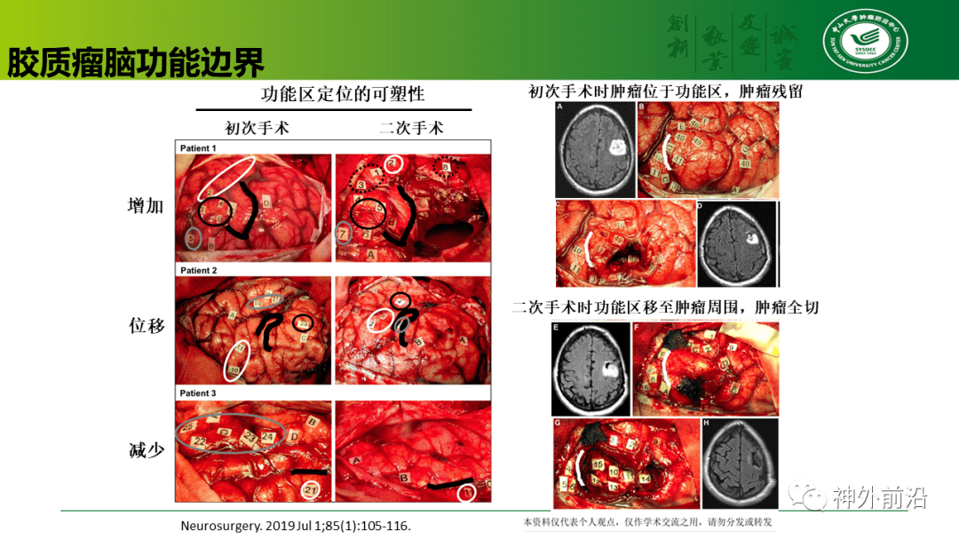 手术前沿 | 中山肿瘤牟永告:胶质瘤"边界" 之我见